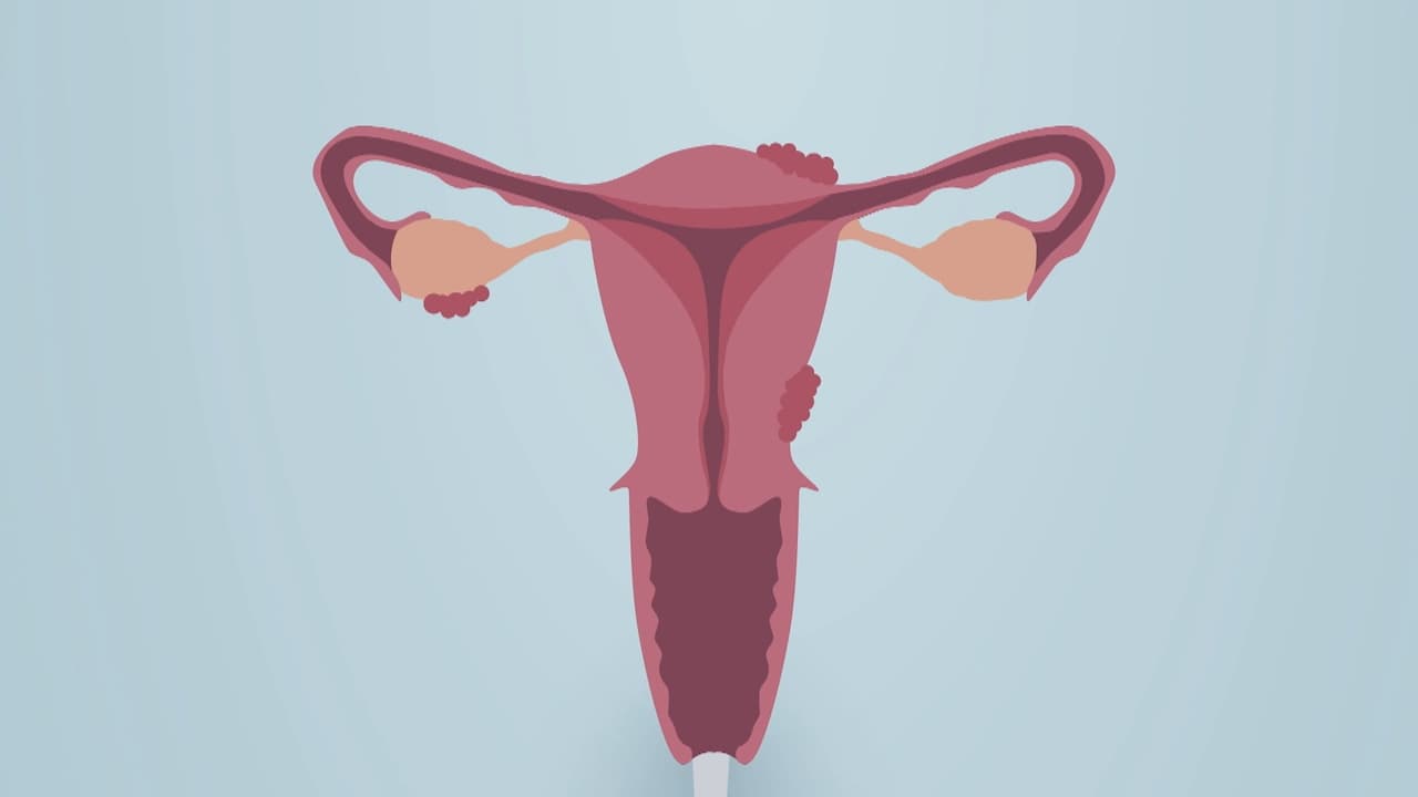 Tabuthema Frauenkrankheit Mehr Als Regelschmerzen Endometriose