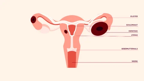 Grafik der Gebärmutter mit Endometriose