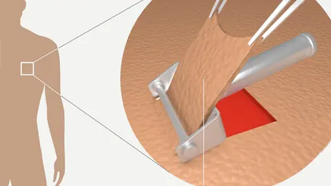 Grafische Darstellung der Entnahme eines Hautstücks.