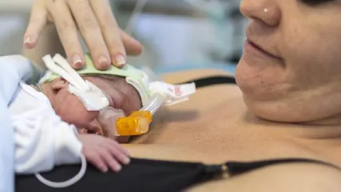 Frau hat ein Frühchen auf der nackten Haut. Das Baby ist an Schläuchen.