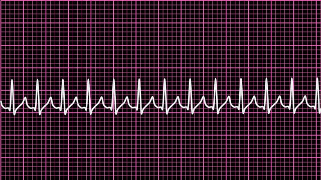 EKG-Bild des Herzrasens.