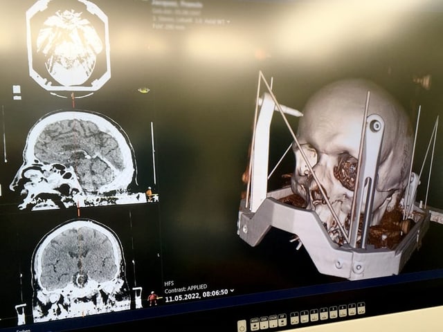 Auf dem Bild ist ein Bildschirm zu sehen. Auf dem Bildschirm ist ein Modell des Kopfes.