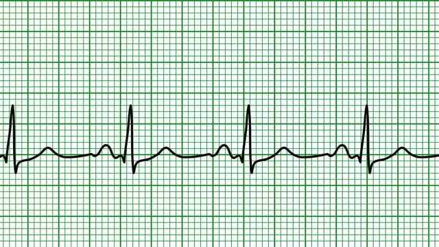 EKG eines normalen Herzschlags