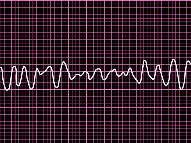 EKG-Aufzeichnung von Kammerflimmern.