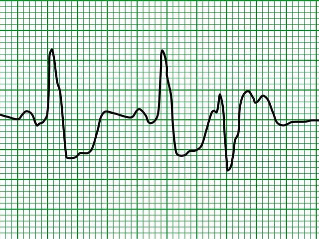 EKG-Aufzeichnung einer ventrikulären Extrasystole