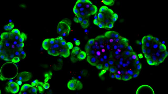 Auf dem Bild sind Blasenkrebs-Organoide zu sehen.