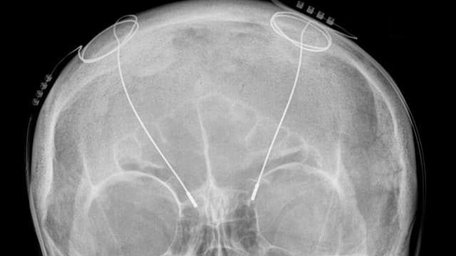 Röntgenaufnahme der Sonden eines Hirnschrittmachers