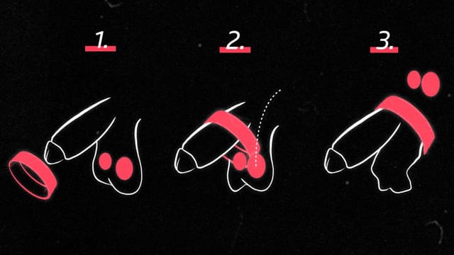 3 Zeichnungen von Penis mit Hoden. 1.: Penisring vor Penis. 2.: Penisring über Penis. 3:. Hodensack durch Ring gezogen. 