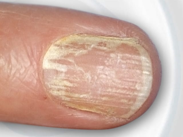 Mit Nagelpilz befallener Fingernagel.