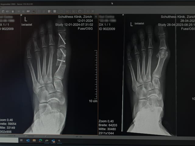 Röntgenaufnahme eines Fusses mit Schrauben und ohne Schrauben.