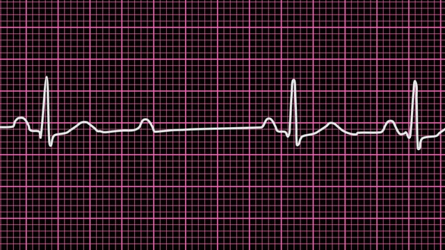 EKG-Aufzeichnung eines AV-Blocks 2. Grades