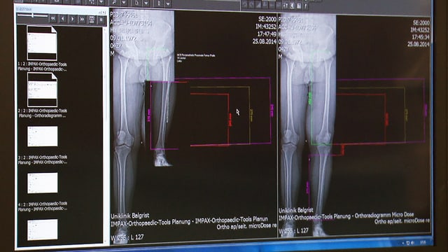 Vergleichende Röntgenaufnahme vor und nach der Operation