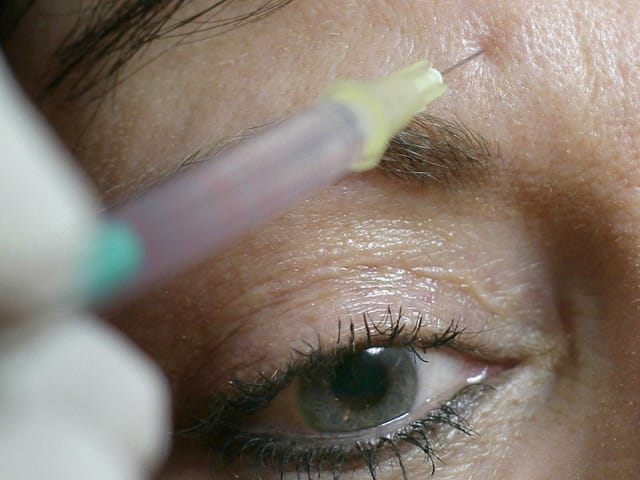 Eine Botox-Injektion an der Stirn einer Patientin.