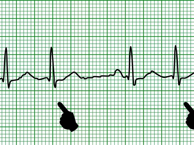 Extrasystolen auf einem EKG.