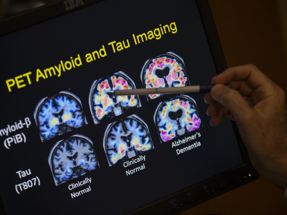 Hand zeigt auf PET-Scans von Hirn zur Analyse von Alzheimer.