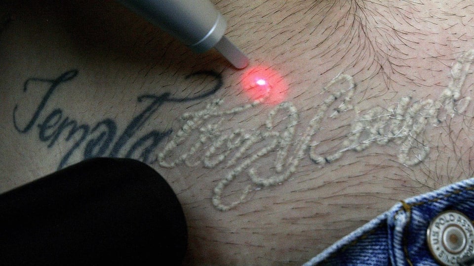 Mit einem roten Laserpunkt wird ein Tattoo von einem männlichen Bauch entfernt.